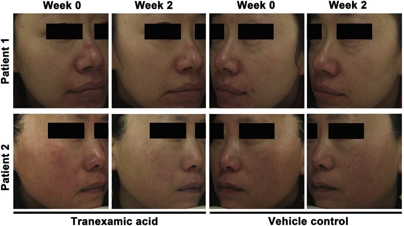 TRX hiệu quả trong PIE, Rosacea