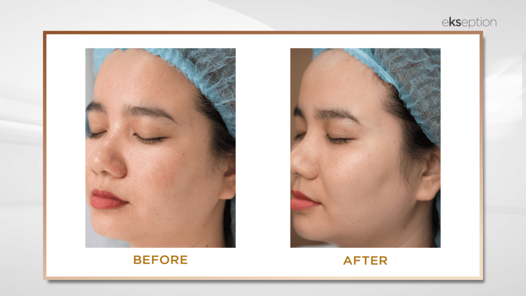 kết quả điều trị couperix peptide peel