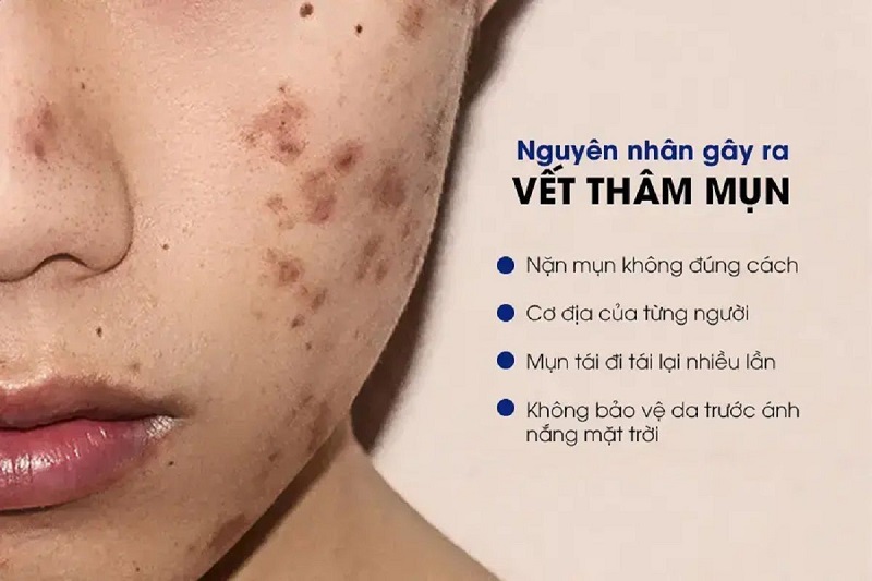 4 tác nhân gây ra mụn thâm