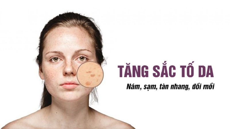 các vấn đề khi da tăng sắc tố