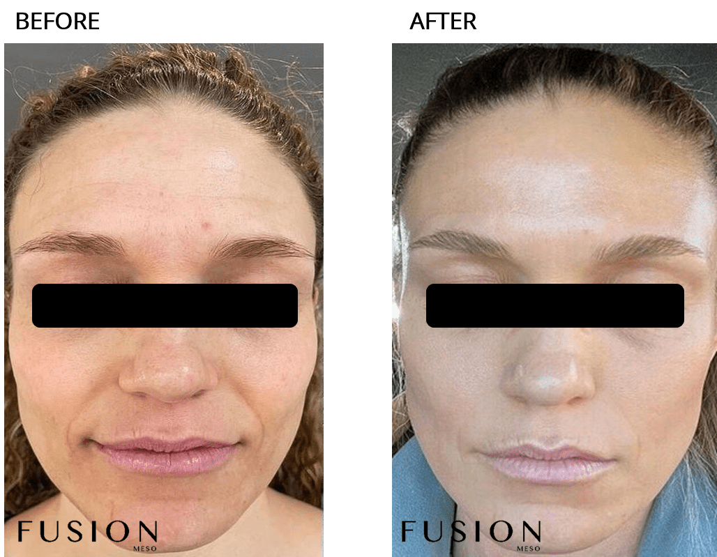 fusion meso F-HA sau 2 lần 