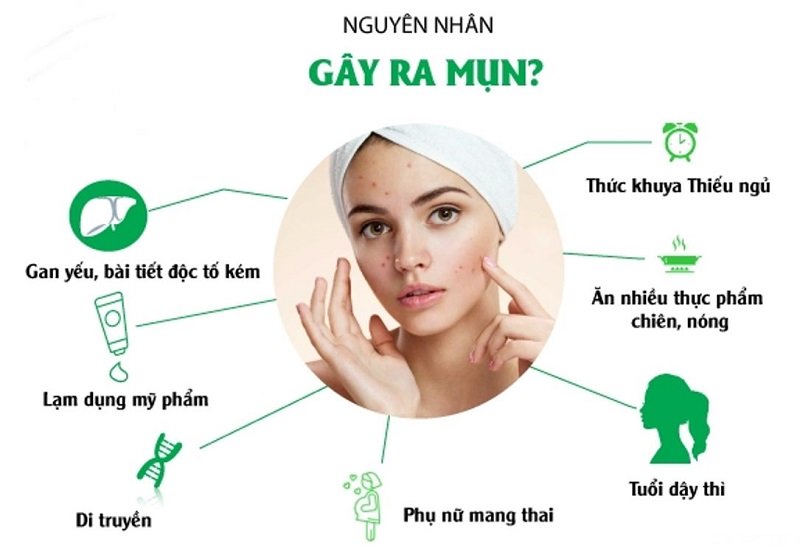 nguyên nhân gây mụn chứng cá