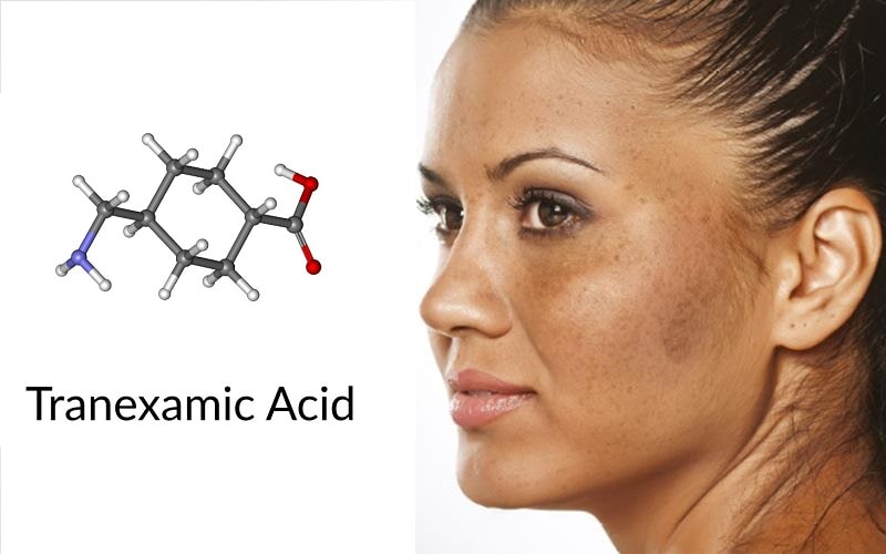 Tranexamic acid là một dạng tổng hợp của lysine
