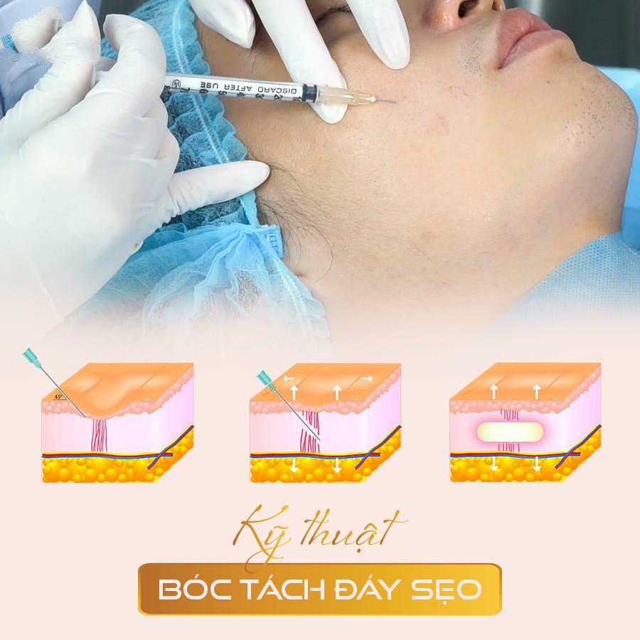 bóc tách sẹo