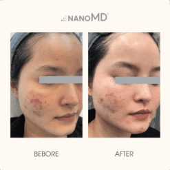 hiệu quả điều trị nanomd brit-n 2.0