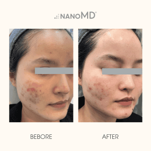 hiệu quả điều trị nanomd brit-n 2.0