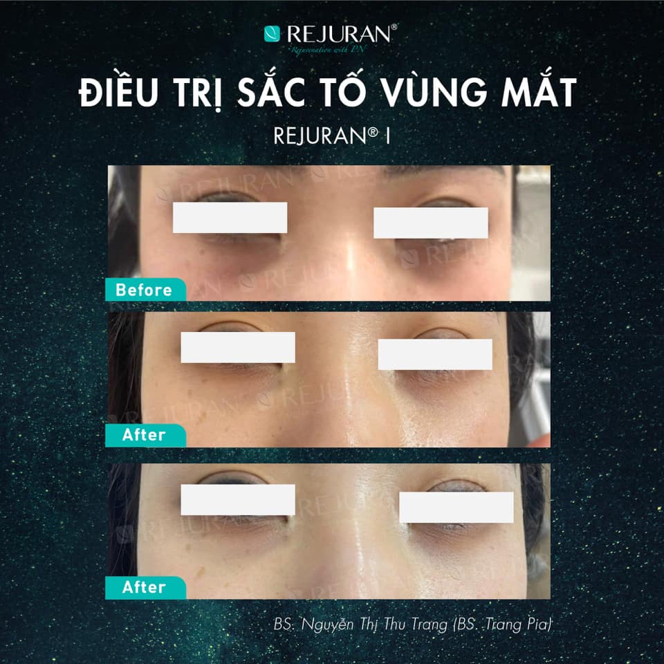 Ứng Dụng Rejuran i Điều Trị Sắc Tố Vùng Mắt cùng TS. BS Nguyễn Thị Thu Trang (Dr. Trang Pia)