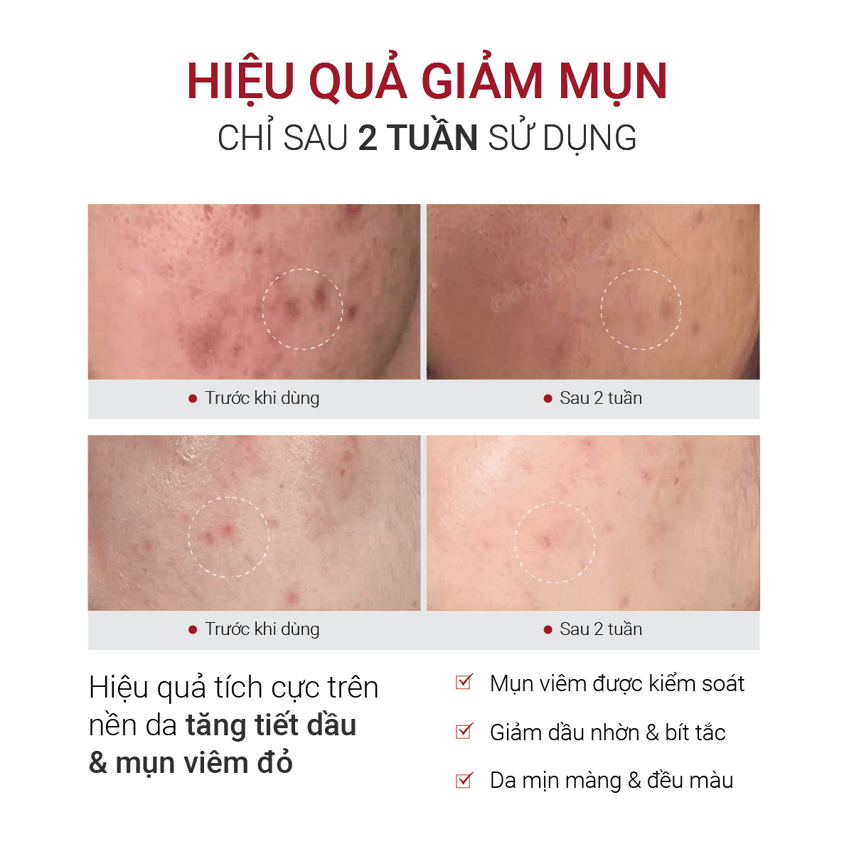 Hiệu quả giảm mụn cải thiện nền da của Fusion Retinol 0.3%