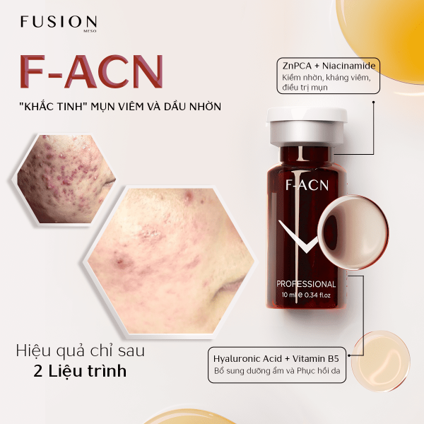 f-acn điều trị mụn trứng cá