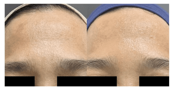 báo cáo lâm sàng của cyntra