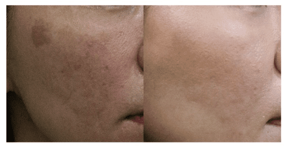 báo cáo lâm sàng của cyntra