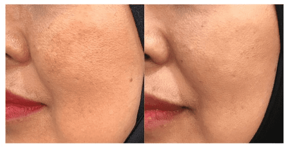 báo cáo lâm sàng của cyntra