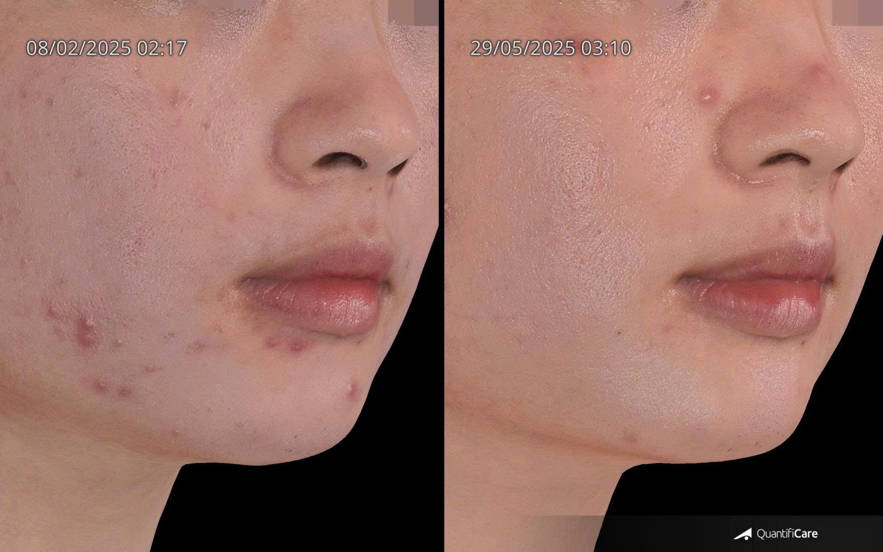 fusion retinol 0.3% phiên bản mới